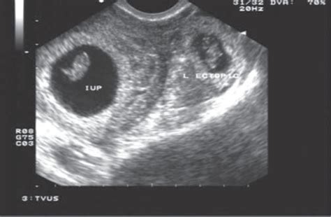 Ectopic Pregnancy Ultrasound