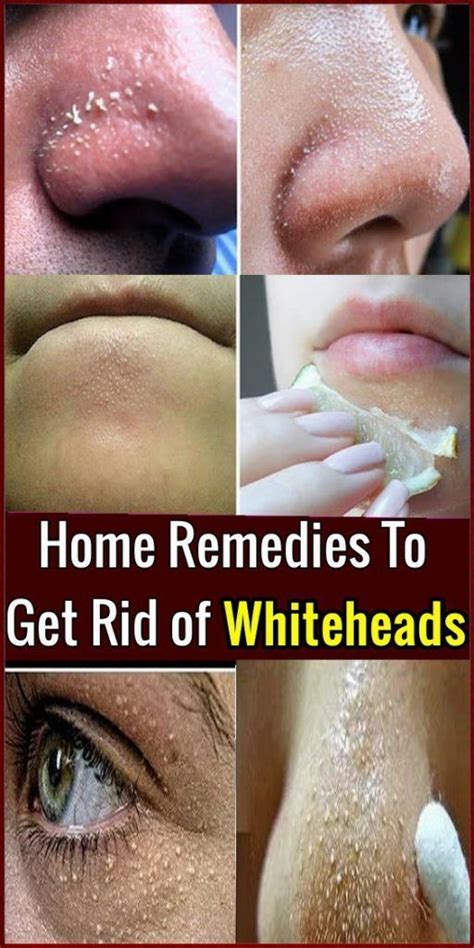 Whiteheads - Home Remedies To Get Rid of Whiteheads Face Errors | Oily face remedy, Oily face ...