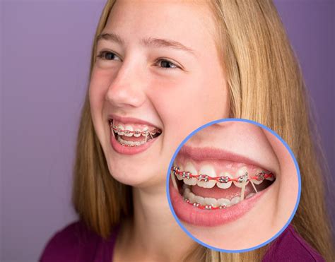 How To Put Rubber Bands On Braces Triangle – Dunya led