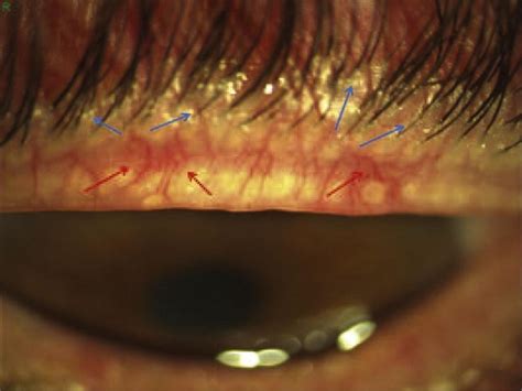 Anterior blepharitis of a mixed type of the upper eyelid. This shows a... | Download Scientific ...