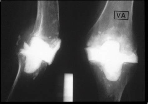 Arthrodesis and Resection Arthroplasty of the Knee | Musculoskeletal Key