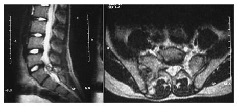 MRI showing a lesion encroaching on the sacral canal and compressing... | Download Scientific ...