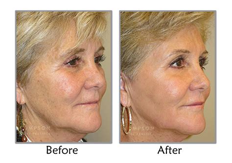 fractional laser resurfacing - pictures, photos