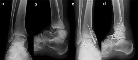 Prosthetic joint infection after total talar replacement: An implant ...