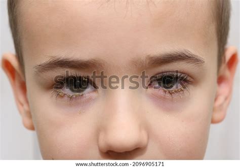 1.933 Infection Of Baby Eye Images, Stock Photos & Vectors | Shutterstock