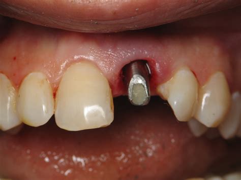 Immediate Front Tooth Dental Implant Example -(Difficult Case) | Ramsey A. Amin, DDS