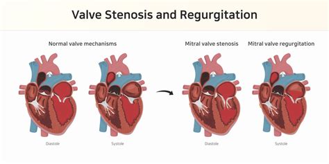 Heart Valve Disease Diagrams Heart Valve Diseases