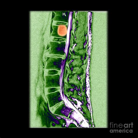 Mri Of Vertebral Hemangioma Photograph by Living Art Enterprises - Fine Art America