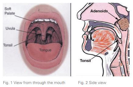 Swollen Tonsils And Adenoids | My XXX Hot Girl