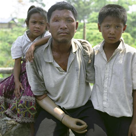 Cluster Bomb Victims: Real-life stories | Scoop News