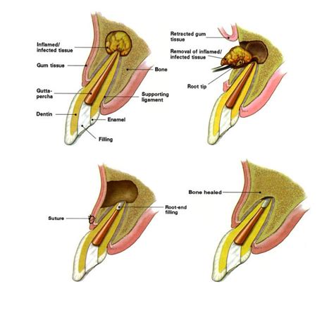 Apicoectomy procedure explained | News | Dentagama