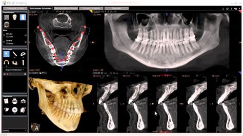 CT scans of the TMJ