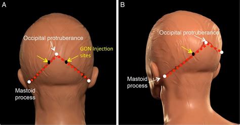 Injection sites for greater occipital nerve (GON) block. The injection ...