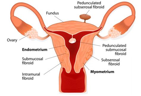 Polyps, Fibroids, or Cysts: What’s the Difference?