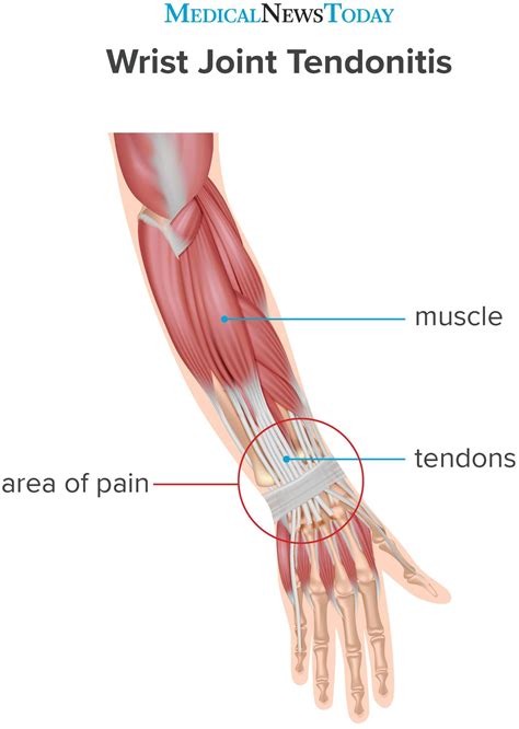 What to know about wrist tendonitis