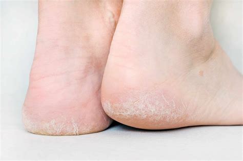 What causes cracked heels: prevention and the best home remedies ...