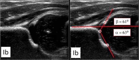 Developmental Dysplasia Of The Hip Ultrasound