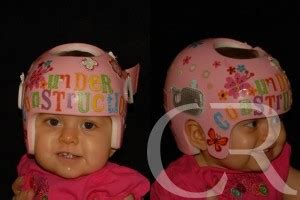 Plagiocephaly - Kentucky Center for Cosmetic & Reconstructive Surgery