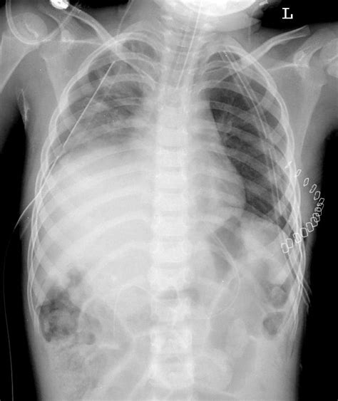 Preoperative (2nd operation) chest X-ray show elevated right diaphragm... | Download Scientific ...