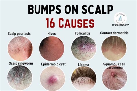 What Are Scalp Bumps And Their Causes Head And Shoulders In | Porn Sex ...