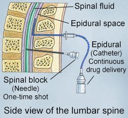 Difference Between Spinal and Epidural Block in 2020 | Epidural, Spinal fluid, Spinal