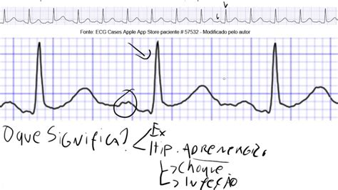 Descomplicando o ECG - Aula 10 - Arritmia sinusal, taquicardia sinusal ...