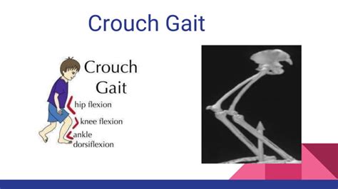 Crouch gait and its brief Medical And Physiotherapy Management | PPT