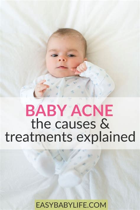 Baby Acne 101 – The Causes And Treatments Explained (New Baby Q&A)