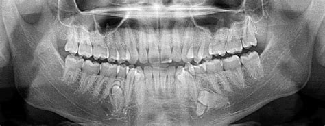 Charting Supernumerary Teeth | Dentrix Ascend