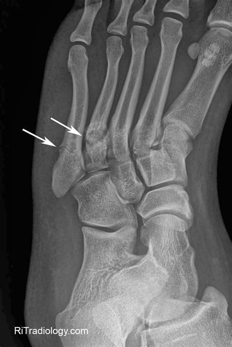 RiT radiology: Metatarsal Stress Fracture