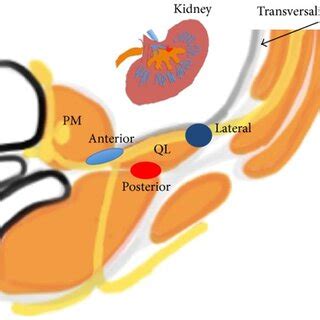 Anatomical view of the QL block (lateral, anterior, and posterior) (50) | Download Scientific ...