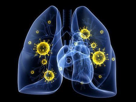 Bacterial Pneumonia: Causes, Symptoms and Treatments | MD-Health.com