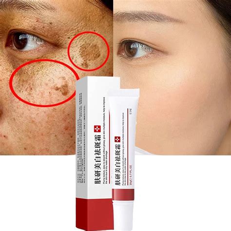 Dark Spots Removal Cream - Effective Whitening Freckle Cream Remove ...