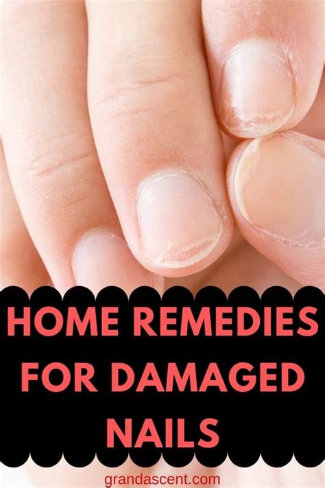 Top 133+ nail pitting home remedies - ceg.edu.vn