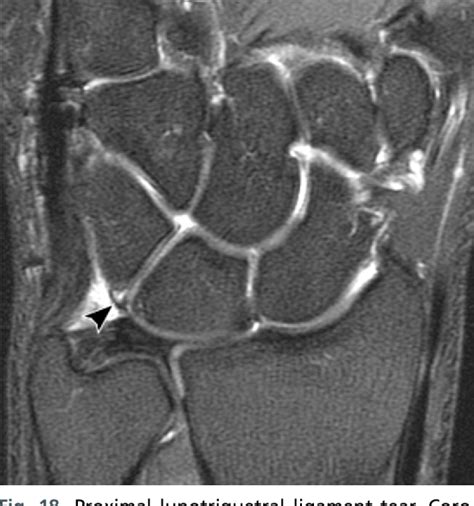 Figure 18 from MR Imaging of Wrist Ligaments. | Semantic Scholar