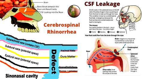 Spinal Fluid Leak From Nose