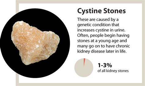 Kidney stones, a marker of overall kidney health - Heersink School of Medicine News | UAB