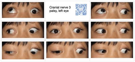 Cranial Nerve Palsy | 3rd nerve palsy | 4th nerve palsy | 6th nerve palsy