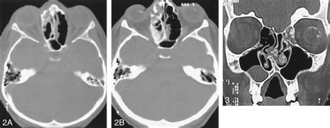 Axial cranial CT scan (A) shows the ethmoid bone lesion with a mixture... | Download Scientific ...