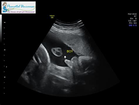 3D Ultrasound Pricing - Prenatal Universe - Tacoma, WA