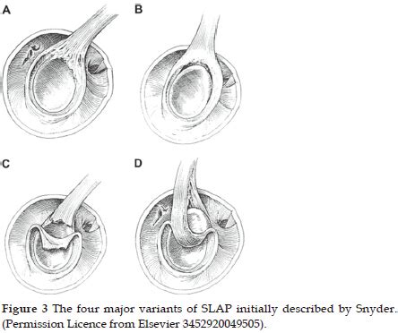 Current trends in the management of Long Head of Biceps Tendon pathology | Boutsiadis ...