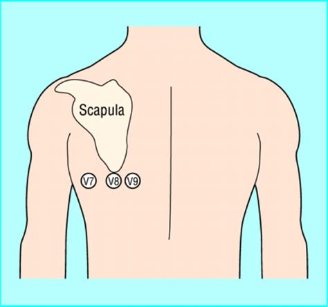 Pin on nurse info | Ekg, Ekg placement, Ekg leads