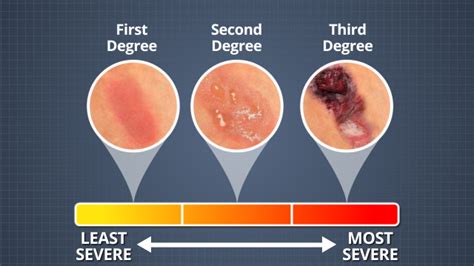 First Degree Burn First Aid