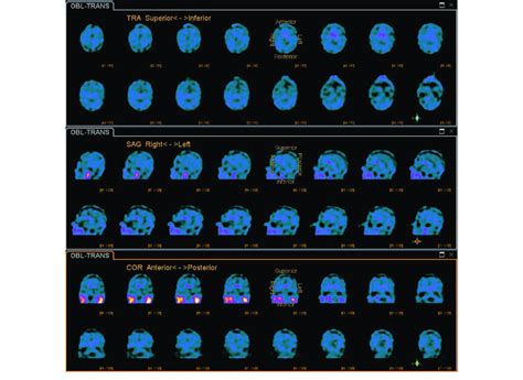 Dopamine transporter (DaT) scan SPECT. Top: Axial, Middle: Sagittal and... | Download Scientific ...