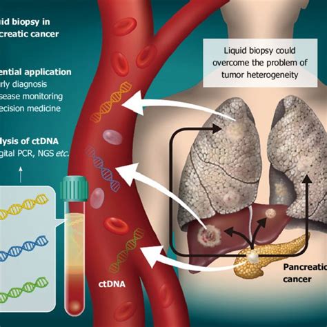 Liquid biopsy for pancreatic cancer. Circulating tumor DNA (ctDNA) can... | Download Scientific ...