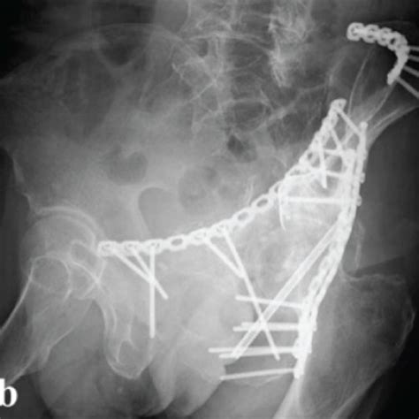 (a) Anteroposterior view and (b, c) Judet views of radiographs at the... | Download Scientific ...