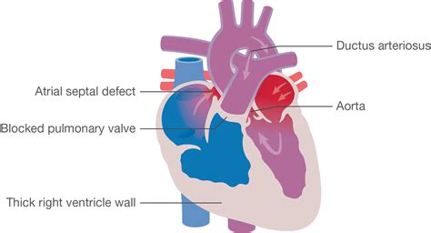 Pulmonary Atresia Ppt