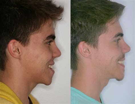 Corrective Jaw Surgery | Orthognathic Surgery | Misaligned Jaws