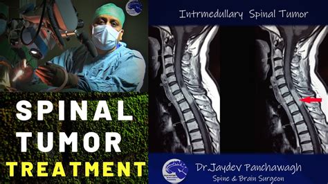 Spinal Tumor symptoms. Treatment with surgery. Dr Jaydev Panchwagh ...