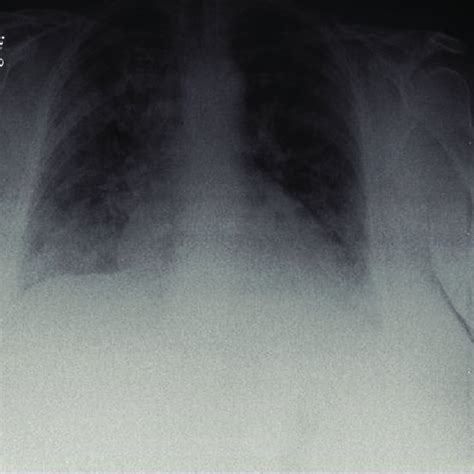 (PDF) Acute Interstitial Pneumonia (Hamman-Rich Syndrome) as a Cause of Idiopathic Acute ...